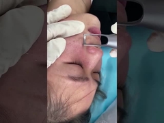 เครื่องเลเซอร์ Picosecond Salon 1064nm 532nm สำหรับการรักษาปัญหารอยโรคผิวคล้ำ